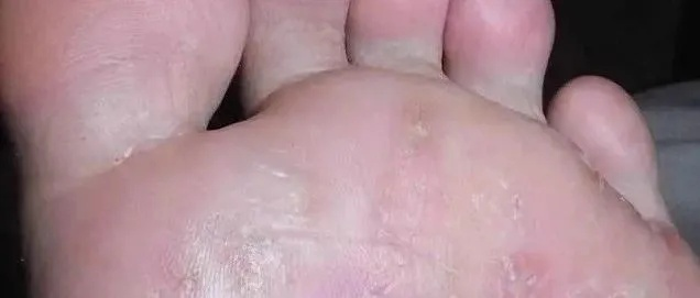 脚底长了像水泡一样的东西很痒什么原因(脚底长了像水泡一样的东西很痒什么原因呢) 脚底长了像水泡一样的东西很痒什么原因(脚底长了像水泡一样的东西很痒什么原因呢)